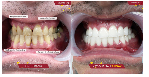   Bạn nên bọc răng sứ Cercon khi răng bị vỡ hoặc sâu nhiều  