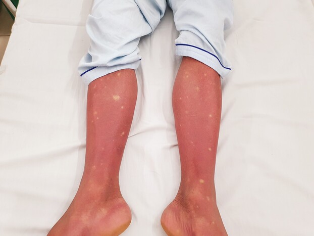   Hình ảnh xuất huyết trên chân của bệnh nhân sốt xuất huyết  
