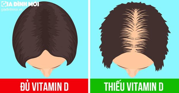 6 dấu hiệu bạn đang thiếu vitamin D trầm trọng 0