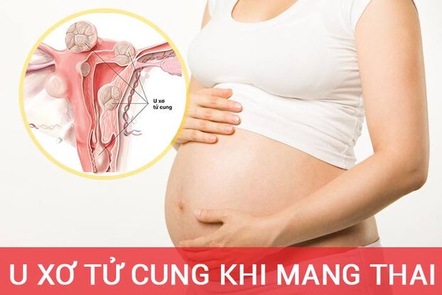 U xơ tử cung khi mang thai tiềm ẩn nhiều nguy cơ cho cả mẹ và bé. Ảnh minh họa