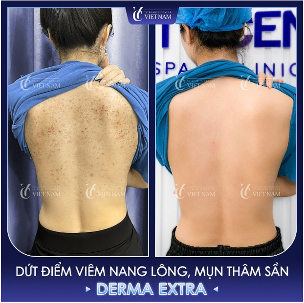 Trước và sau điều trị viêm nang lông vùng lưng của chị Thu Hiền - 36 tuổi - Bắc Giang