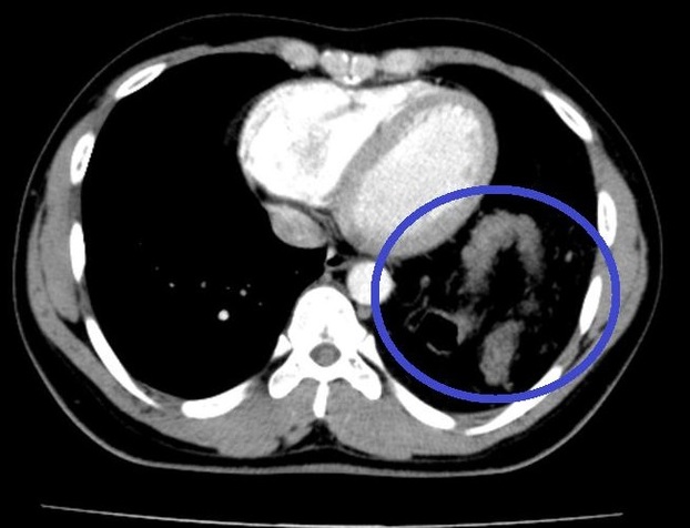 Hình ảnh đại tràng nằm trong ngực trái trên Cắt lớp vi tính ngực