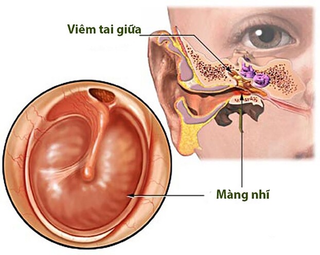 Bệnh viêm tai giữa rất dễ gây ra thủng màng nhĩ. Ảnh minh họa