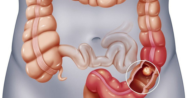 Bản chất của polyp đại tràng không phải u mà là một tổn thương có hình dạng giống như một khối u.