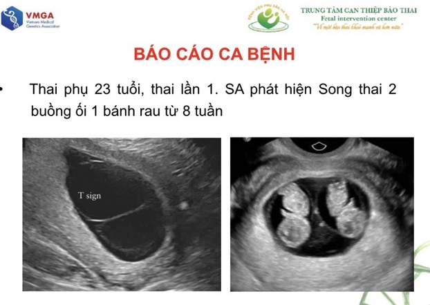 Ca song thai cùng trứng nhưng khác nhau về kiểu gen và kiểu hình phát hiện tại BV Phụ sản Hà Nội.