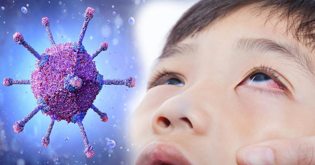 Điều trị viêm kết mạc do Adenovirus không có thuốc điều trị đặc hiệu. Ảnh minh họa