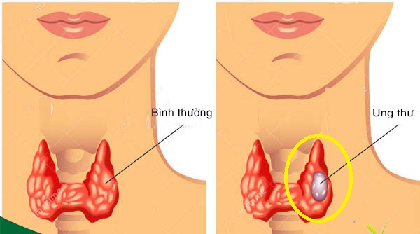 Hệ miễn dịch bị rối loạn làm tăng nguy cơ mắc bệnh ung thư tuyến giáp. Ảnh minh họa