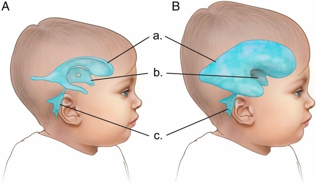 Bệnh não úng thủy là một căn bệnh rất nguy hiểm, làm tổn thương trực tiếp đến hệ thần kinh trung ương. Ảnh minh họa