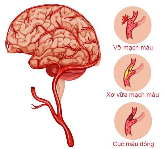 Đột quỵ não là căn bệnh cấp tính, có tính chất nguy hiểm cao. Ảnh minh họa