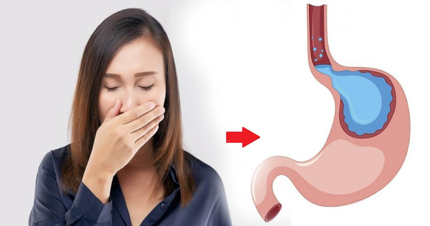 Ợ hơi, ợ nóng, nóng rát cổ họng là dấu hiệu đặc trưng của bệnh trào ngược dạ dày thực quản. Ảnh minh họa