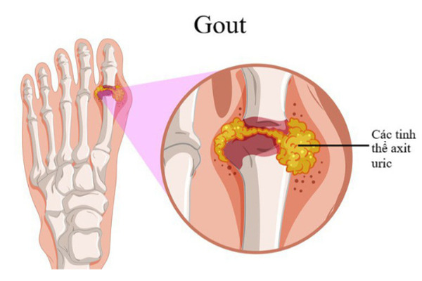 Bệnh Gout do rối loạn chuyển hóa tiêu hóa.