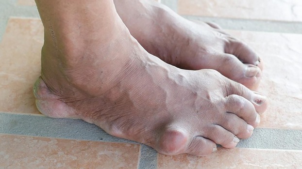 Gout khiến người bệnh phải chịu đựng những cơn đau cấp.