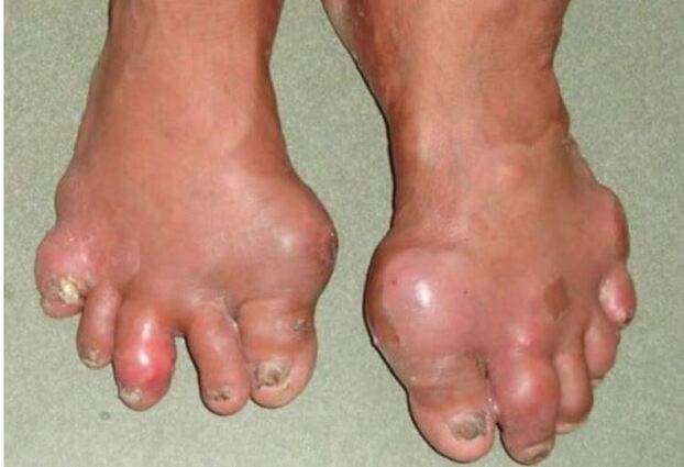 Bệnh Gout biến chứng nổi cục tophi.