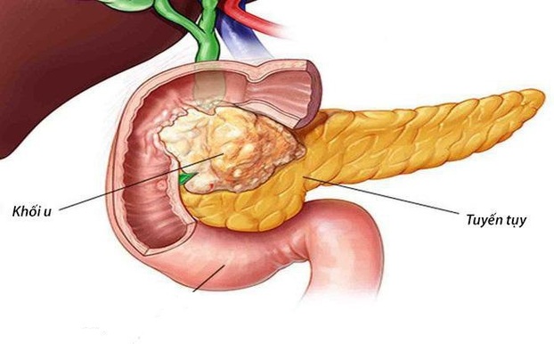 Ung thư tụy là một trong những bệnh lý ung thư ác tính nhất của hệ tiêu hóa. Ảnh minh họa