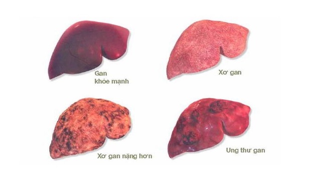 Ung thư gan là sự tăng trưởng và phát triển không kiểm soát của các tế bào ung thư tại gan. Ảnh minh họa