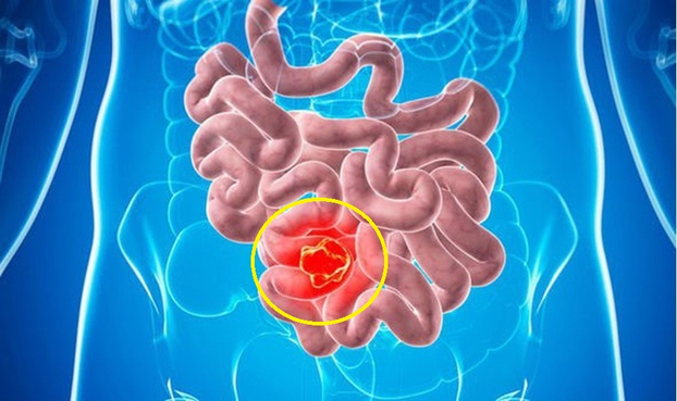 Triệu chứng của bệnh ung thư ruột non dễ bị nhầm với các bệnh tiêu hóa thông thường. Ảnh minh họa