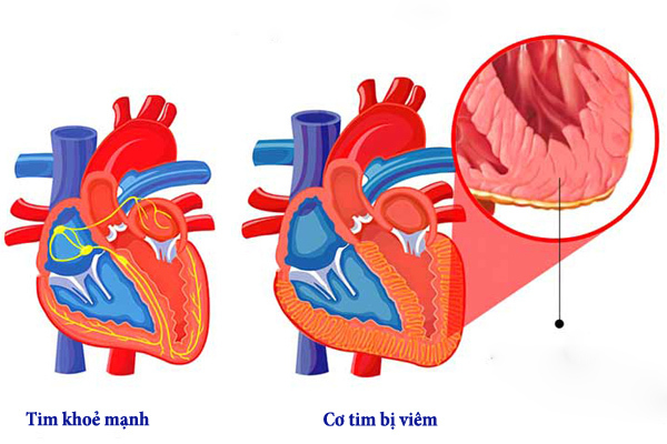 Virus là một trong những nguyên nhân hay gặp nhất gây ra tình trạng viêm cơ tim. Ảnh minh họa