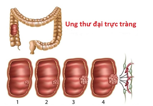 ung-thu-dai-truc-trang