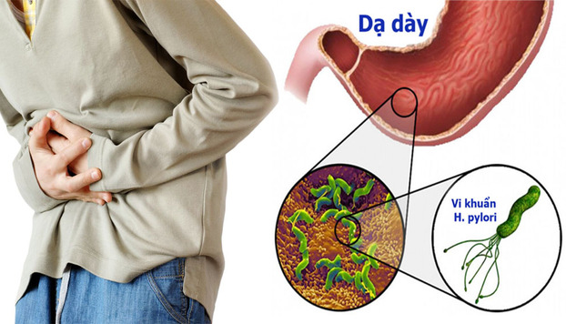 Người nhiễm vi khuẩn H.P có nguy cơ mắc ung thư dạ dày cao hơn so với những người không nhiễm loại vi khuẩn này. Ảnh minh họa