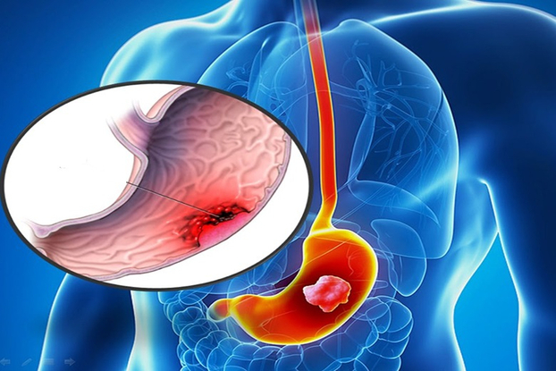 Ung thư dạ dày là một trong những căn bệnh ung thư có tỷ lệ mắc và tử vong cao. Ảnh minh họa
