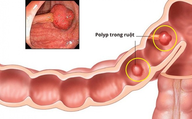 Polyp ở đường ruột có thể gây các triệu chứng xuất huyết tiêu hóa, đau bụng hoặc lồng ruột và có nguy cơ tiến triển thành ung thư. Ảnh minh họa