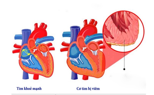 Bệnh viêm cơ tim có thể gây ra nhiều biến chứng nguy hiểm, có thể dẫn đến suy tim cấp, tử vong và có các rối loạn nhịp phức tạp. Ảnh minh họa