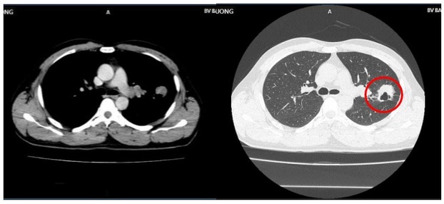 Hình ảnh u thuỳ trên phổi trái, kích thước 30x32mm (vòng tròn màu đỏ), vài nốt mờ rải rác màng phổi 2 bên, hạch trung thất trên hình ảnh chụp cắt lớp của bệnh nhân