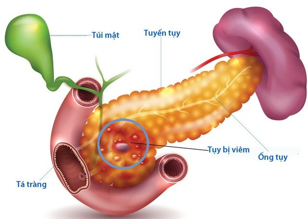 Viêm tụy cấp cần được điều trị kịp thời vì có thể tạo ra cơn bão cytokine, gây nguy hiểm đến tính mạng. Ảnh minh họa