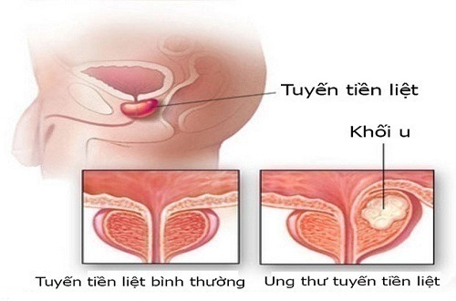 Ung thư tuyến tiền liệt là loại ung thư có xu hướng mắc ngày càng tăng. Ảnh minh họa