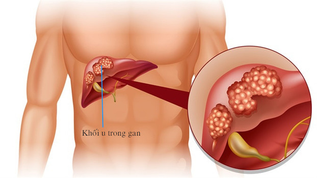 Khối u trong gan nếu không được phát hiện sớm có thể đe dọa đến tính mạng. Ảnh minh họa