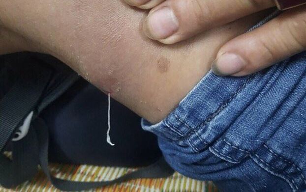 Gái ngứa, người đàn ông rùng mình khi kéo được ổ giun rồng ký sinh dưới da.