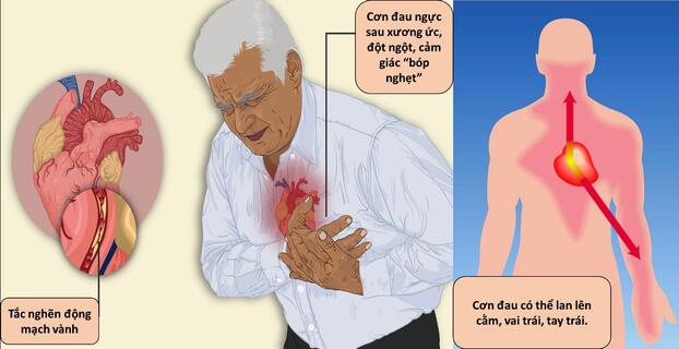 Nhồi máu cơ tim cấp nếu không được điều trị kịp thời có thể gây ra nhiều biến chứng nguy hiểm. Ảnh minh họa