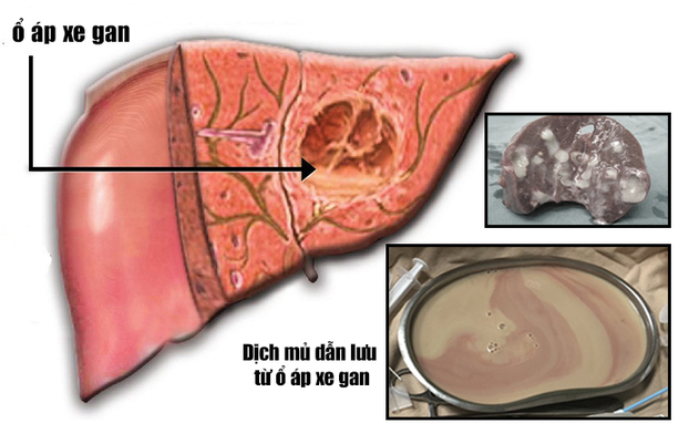 Dịch mủ được chọc dẫn lưu từ ổ áp xe gan của bệnh nhân