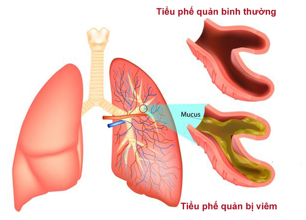 Viêm tiểu phế quản là bệnh dễ mắc ở trẻ nhỏ khi thời tiết chuyển lạnh. Ảnh minh họa