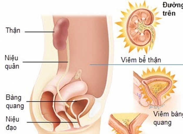 Nhiễm khuẩn tiết niệu là một trong những bệnh nhiễm trùng thường gặp ở trẻ nhỏ. Ảnh minh họa