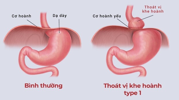 Thoát vị hoành có thể gây ra các triệu chứng nuốt nghẹn, khó nuốt, ăn uống kém, đau bụng, đau ngực... Ảnh minh họa