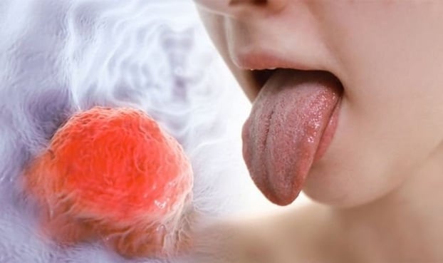 Mảng đỏ hoặc trắng trên lưỡi, vết loét hoặc u trên lưỡi lâu ngày không hết đều là những dấu hiệu cảnh báo bệnh ung thư lưỡi. Ảnh minh họa