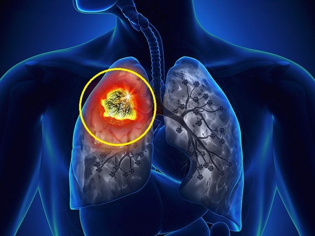 Ung thư phổi là loại ung thư thường gặp thứ 2 trên thế giới. Ảnh minh họa