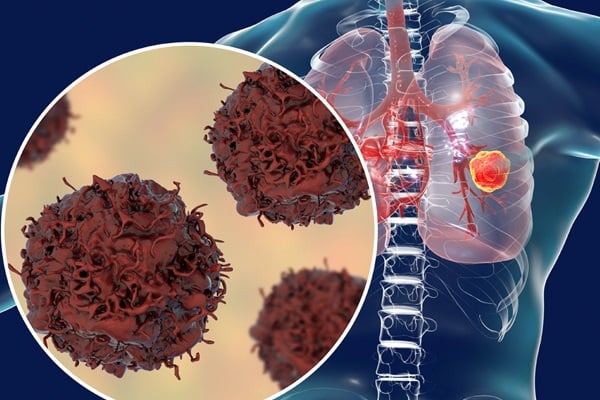 Ung thư phổi là một trong những loại ung thư có tỷ lệ tử vong cao nhất do ung thư. Ảnh minh họa