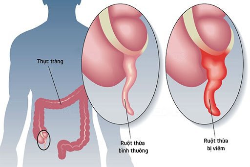 Vị trí của ruột thừa.