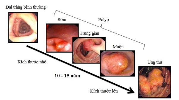 Các giai đoạn phát triển của ung thư đại tràng.