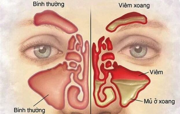 Viêm xoang là tình trạng nhiễm trùng, viêm niêm mạc hô hấp lớp lót trong các xoang cạnh mũi.