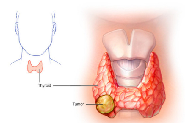 Phần lớn các trường hợp ung thư tuyến giáp giai đoạn đầu không có triệu chứng hoặc triệu chứng rất nghèo nàn.