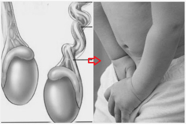 Xoắn tinh hoàn có thể để lại những hậu quả đáng tiếc cho các bé trai. Ảnh minh họa