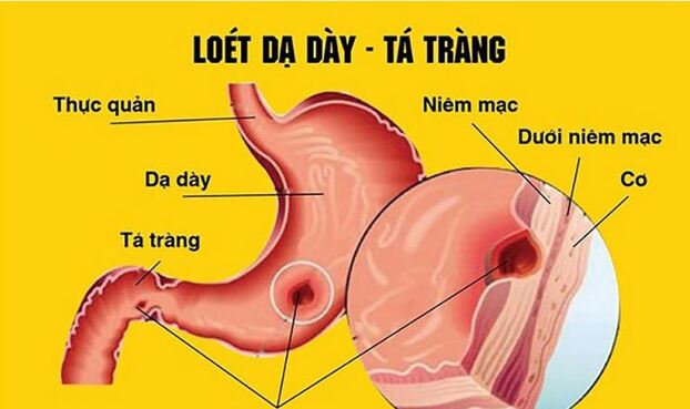 Viêm loét dạ dày là tổn thương gây viêm và loét trên niêm mạc dạ dày. 