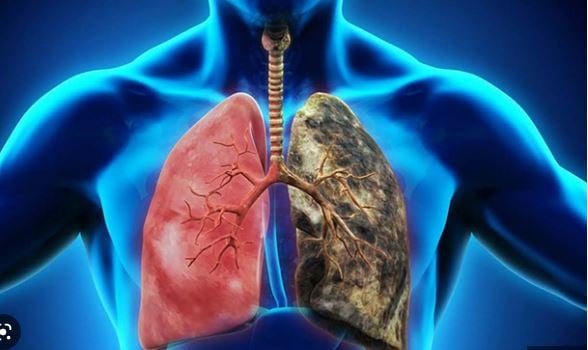 Tỷ lệ mắc bệnh phổi ngày càng gia tăng mạnh mẽ.