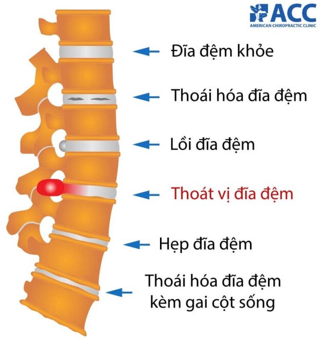 Các tình trạng của đĩa đệm.