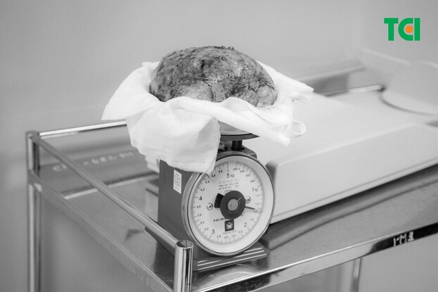 Khối u xơ tử cung “khủng” nặng đến 1.5kg sau khi được phẫu thuật