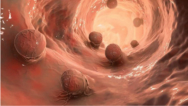 3 dấu hiệu bất thường khi bị polyp đại tràng, cần đi kiểm tra càng sớm càng tốt.