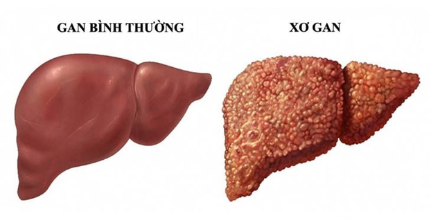 Ăn kiêng, uống sinh tố, làm sạch đại tràng có giúp 'giải độc gan’?.